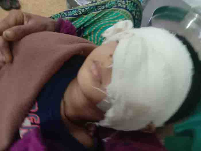 Successful operation of the cancerous eye of masum